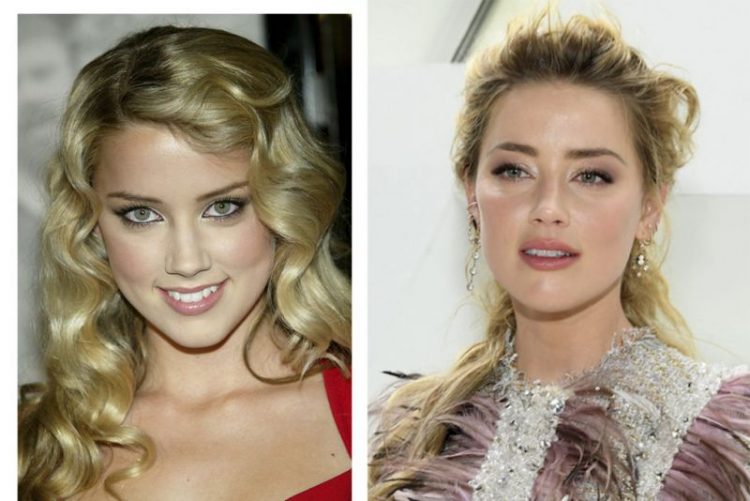 Before and After Plastic Surgery: Stunning Transformations