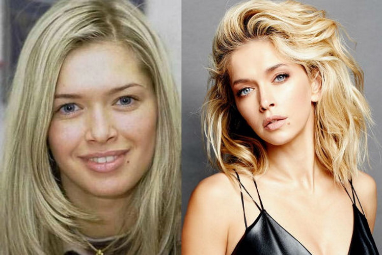 Before and After Plastic Surgery: Stunning Transformations