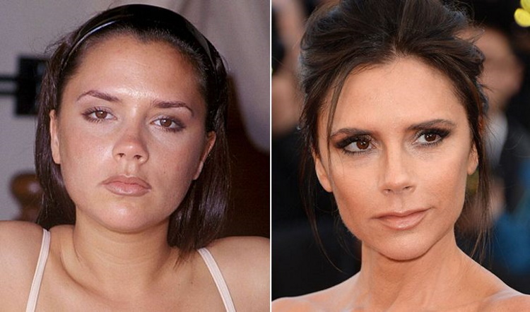 Before and After Plastic Surgery: Stunning Transformations